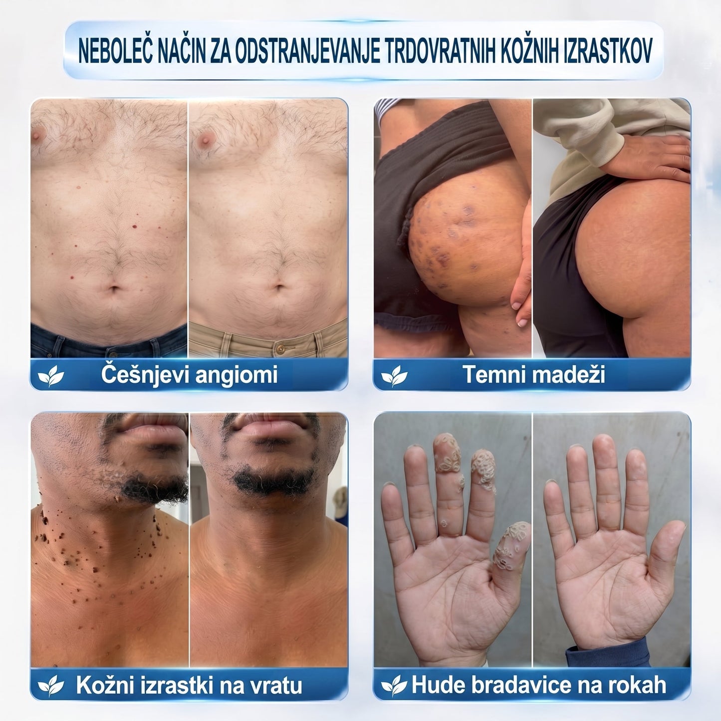 🏥💯𝐏𝒊𝐜𝐝𝒐® 7-𝑫𝒏𝒆𝒗𝒏𝒊 𝑶𝒅𝒔𝒕𝒓𝒂𝒏𝒋𝒆𝒗𝒂𝒏𝒋𝒆 𝑷𝒊𝒈𝒎𝒆𝒏𝒕𝒏𝒊𝒉 𝑴𝒂𝒅𝒆ž𝒆𝒗 𝑰𝒏 𝑩𝒓𝒂𝒛𝒈𝒐𝒕𝒊𝒏 𝑷𝒊𝒔𝒂𝒍𝒐
